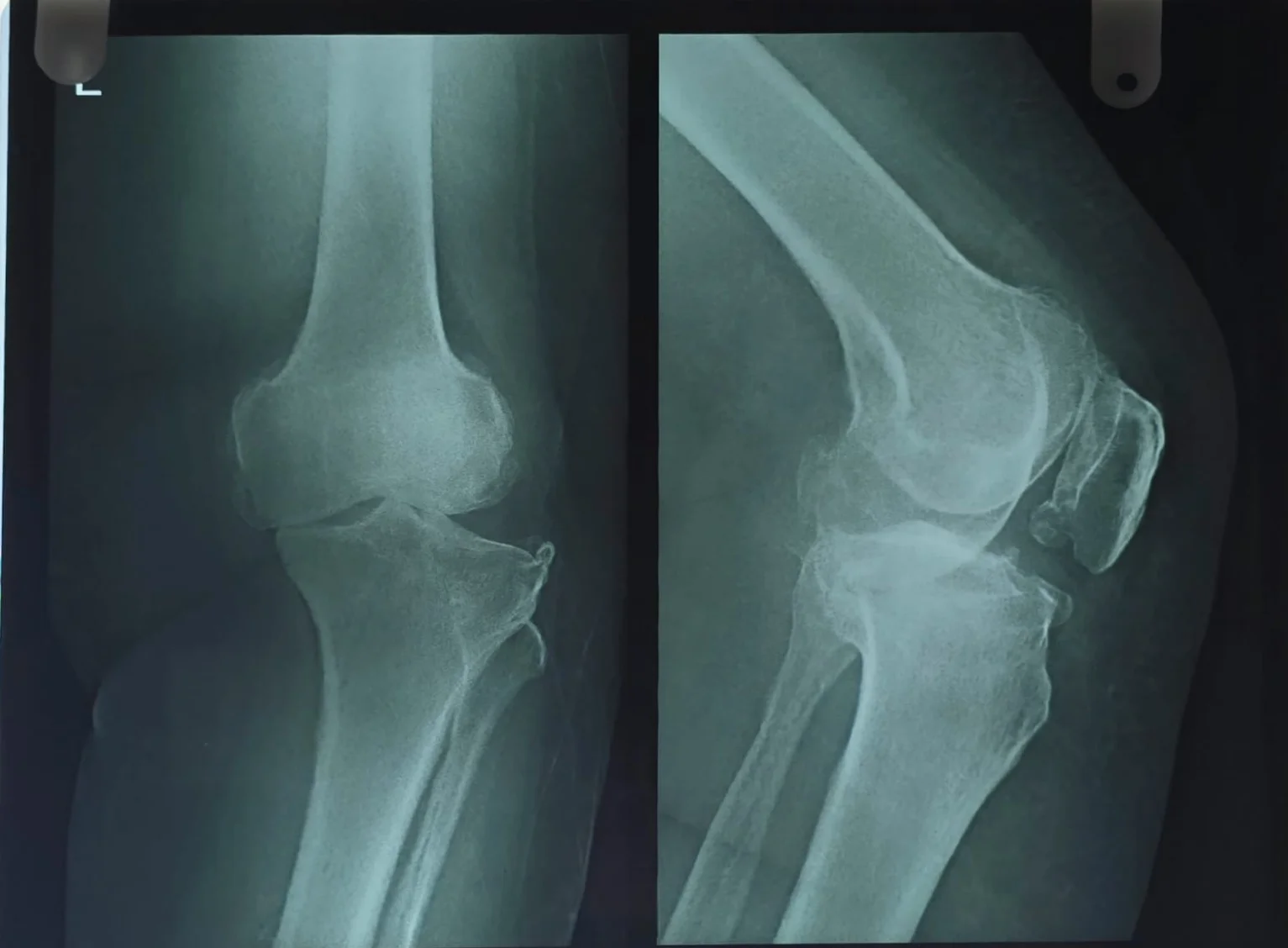 Before bilateral knee replacement X-ray showing arthritic joint