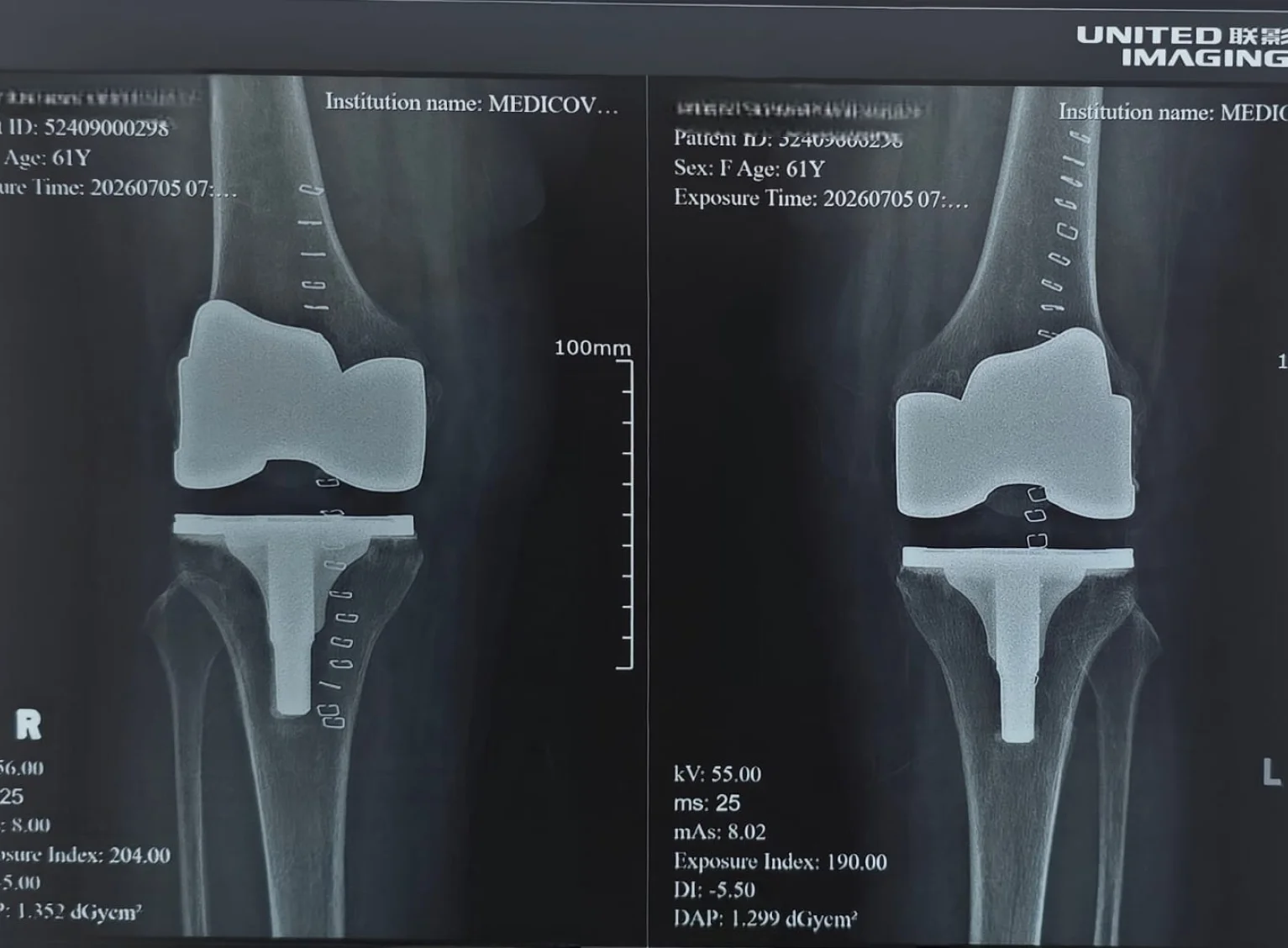 After knee replacement X-ray