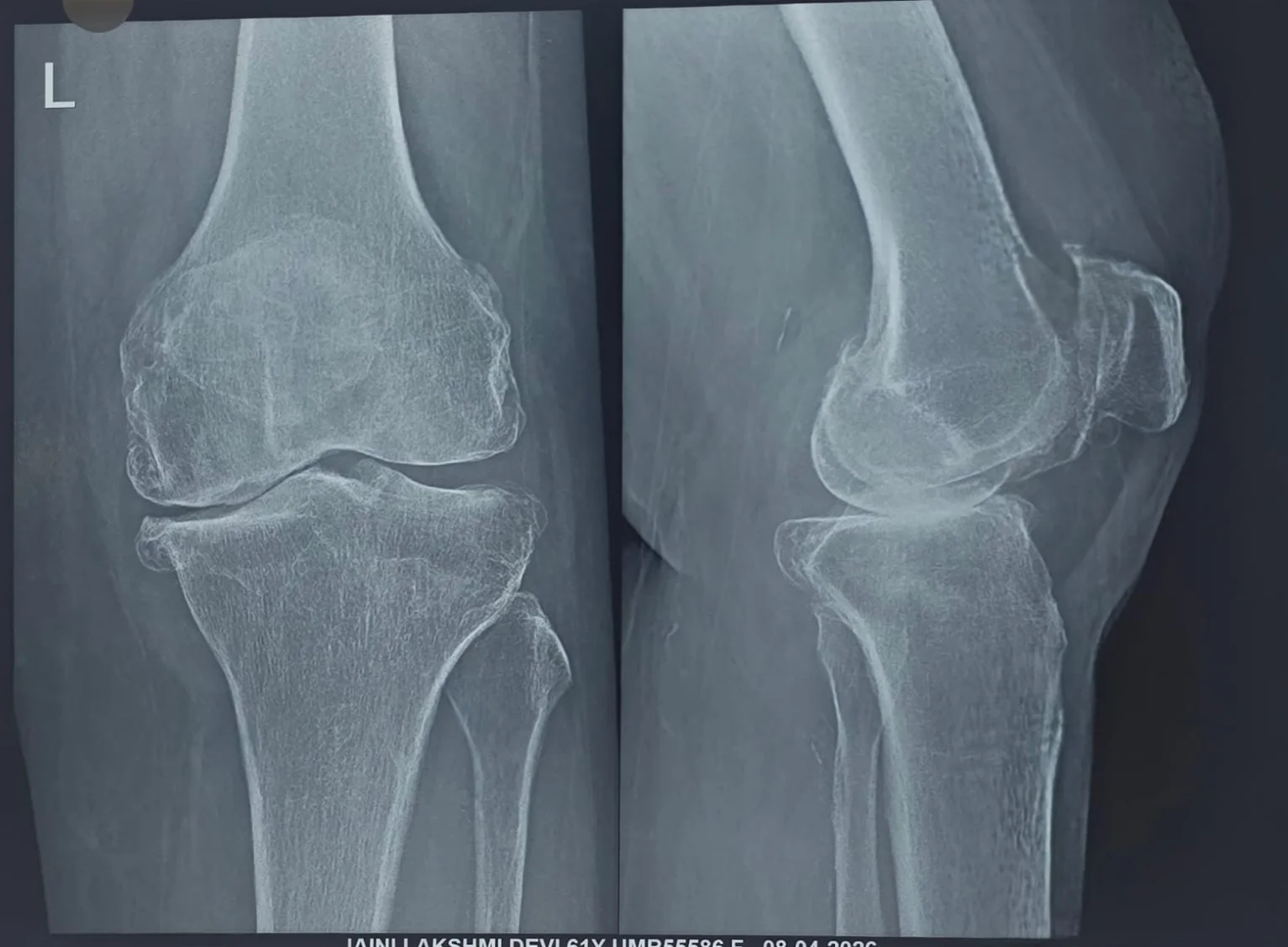 Before knee replacement close-up X-ray showing arthritic joint