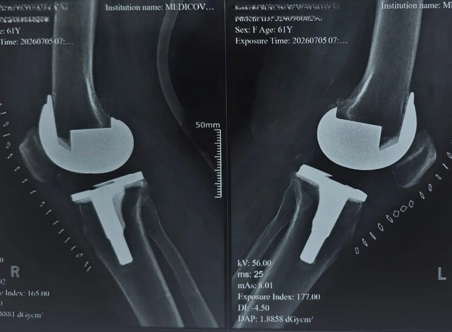 After knee replacement close-up X-ray