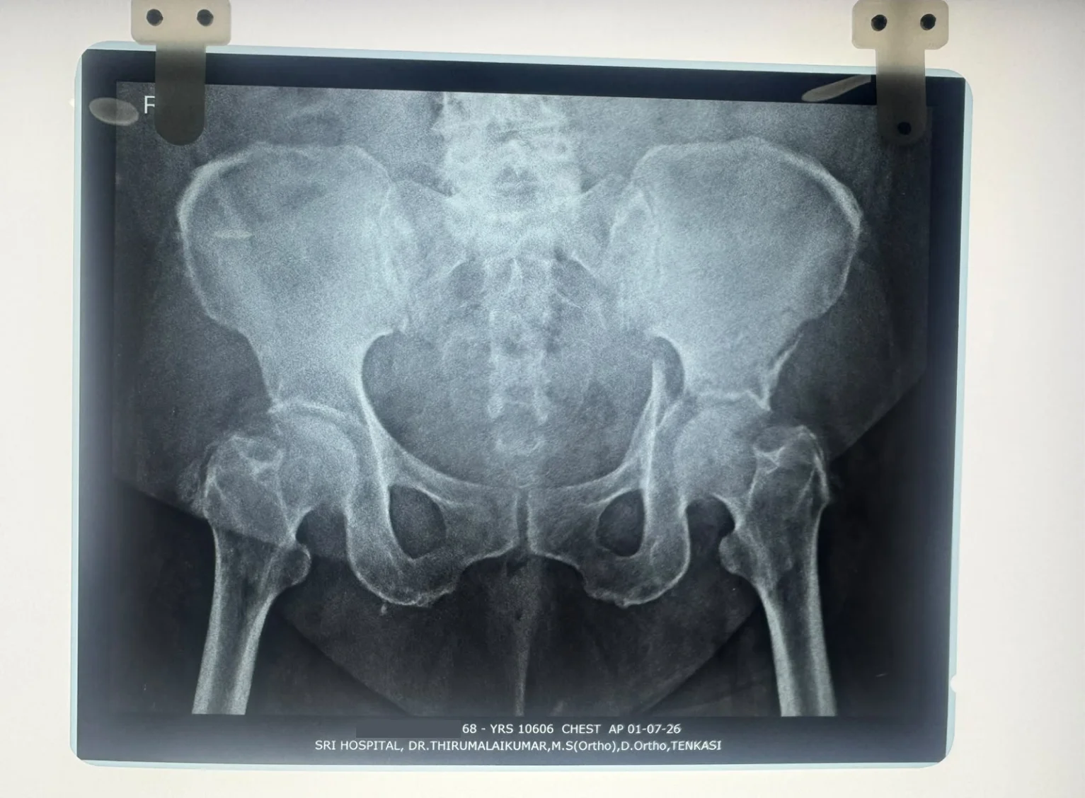 Before hip fracture fixation X-ray