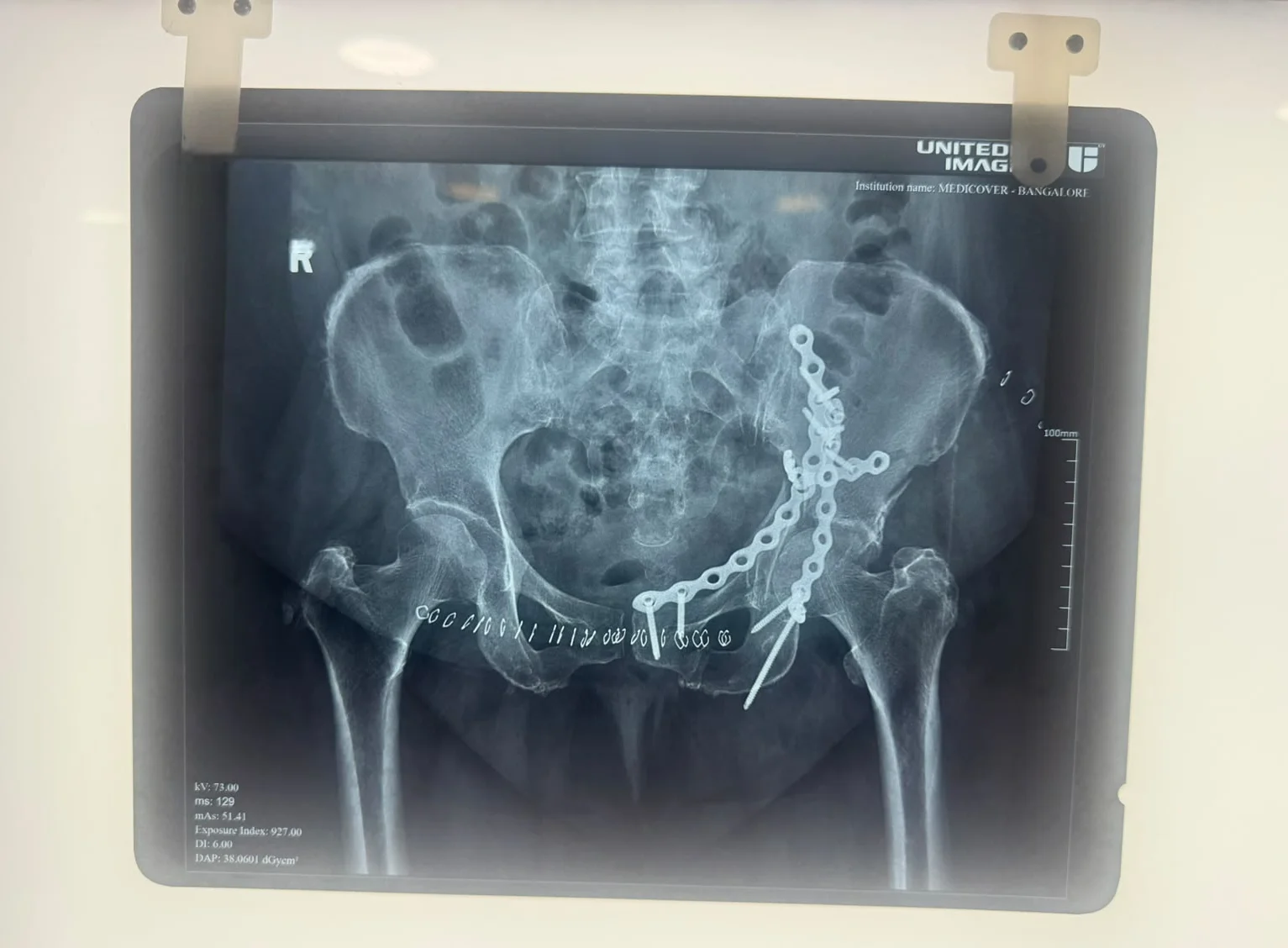 After hip fracture fixation X-ray with plate and screws