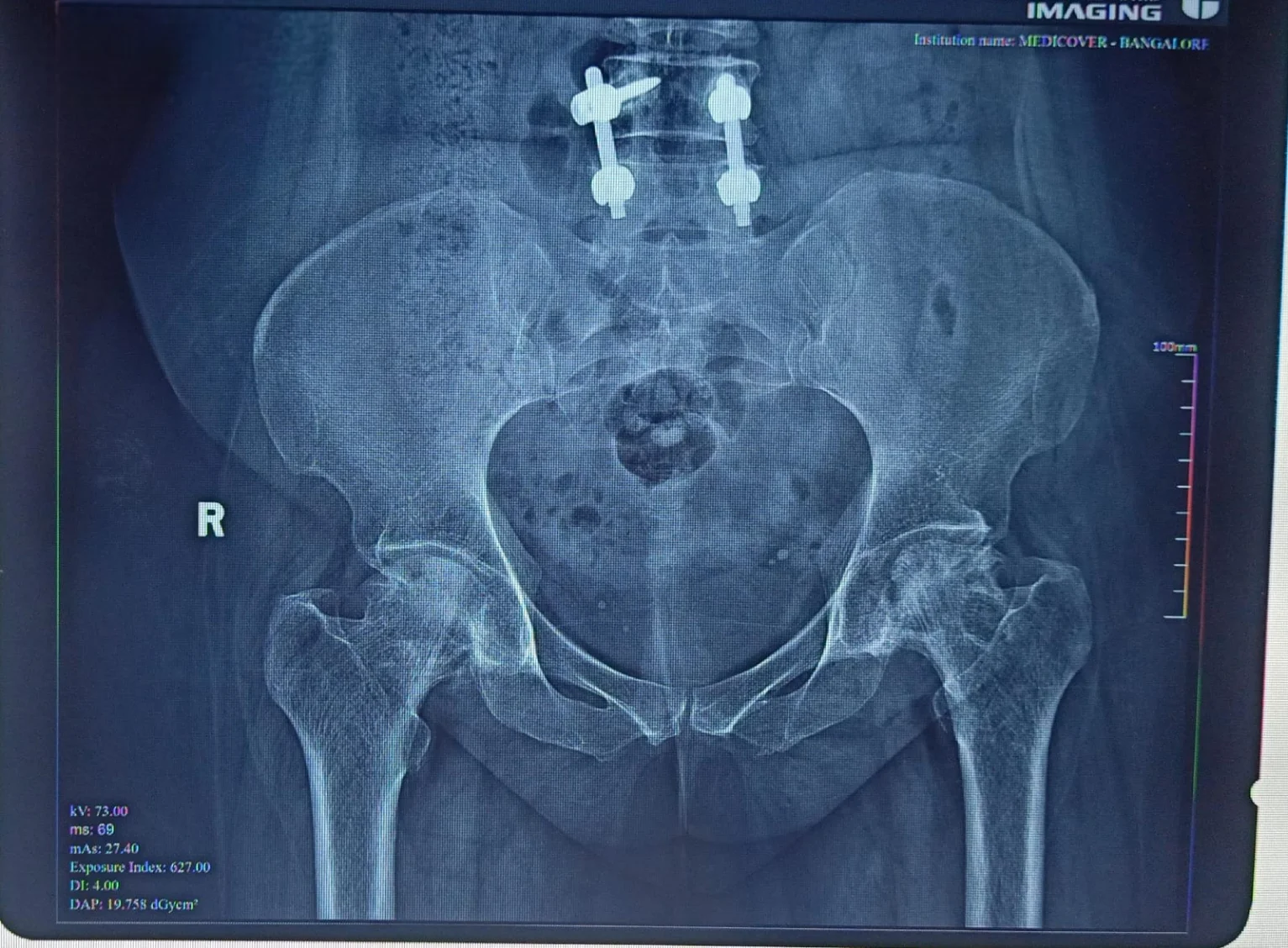 Before hip fracture fixation X-ray