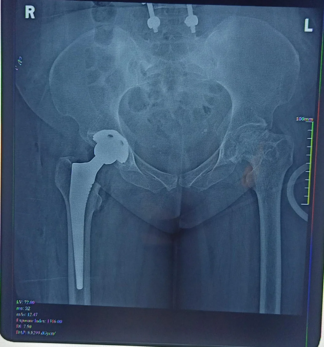 After hip fracture fixation X-ray with plate and screws